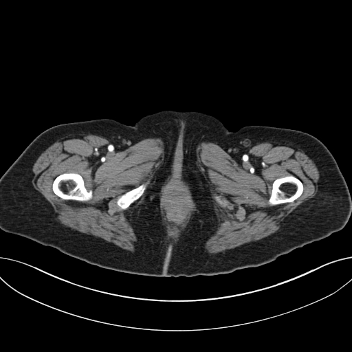 Cholecystoduodenal fistula due to calculous cholecystitis with gallstone migration (Radiopaedia 86875-103077 A 82).jpg