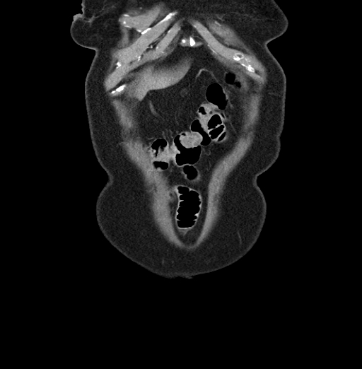 File:Cholecystoduodenal fistula due to calculous cholecystitis with gallstone migration (Radiopaedia 86875-103077 B 6).jpg
