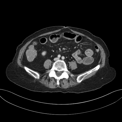 Cholecystoduodenal fistula due to calculous cholecystitis with gallstone migration (Radiopaedia 86875-103077 D 50).jpg