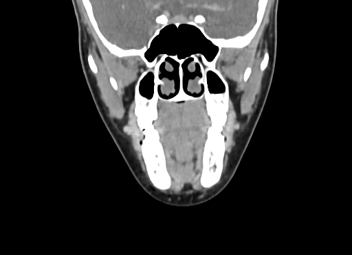 Chondroblastic osteosarcoma (Radiopaedia 67363-76741 D 42).jpg