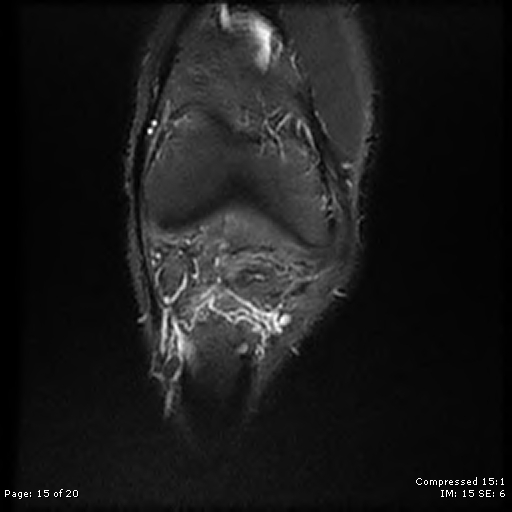 File:Chondroblastoma (Radiopaedia 25725-25891 Coronal STIR 15).jpg