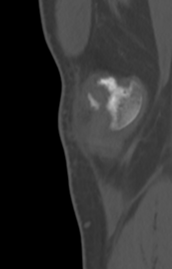 Chondrocalcinosis (Radiopaedia 82862-97173 Sagittal bone window 2).jpg