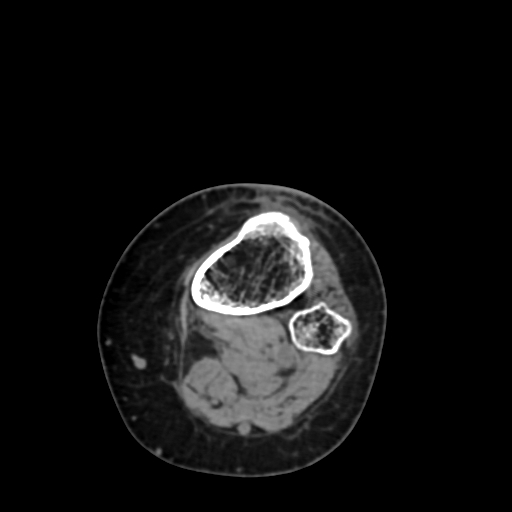 Chondrosarcoma - femur (Radiopaedia 64187-72954 Axial non-contrast 75).jpg