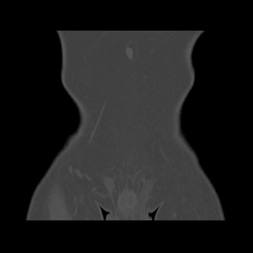 Chondrosarcoma of iliac wing (Radiopaedia 63861-72599 Coronal bone window 19).jpg
