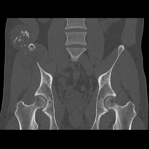 Chondrosarcoma of iliac wing (Radiopaedia 63861-72599 Coronal bone window 64).jpg