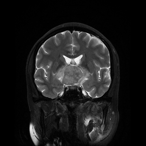 File:Chordoid glioma of third ventricle (Radiopaedia 91612-109340 Coronal T2 13).jpg