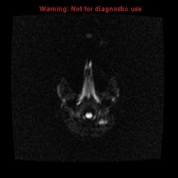File:Choroid plexus carcinoma - recurrent (Radiopaedia 8330-9169 Axial DWI 2).jpg