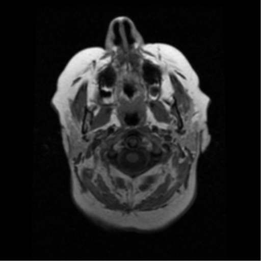 File:Choroid plexus papilloma (Radiopaedia 33040-34052 Axial T1 2).png