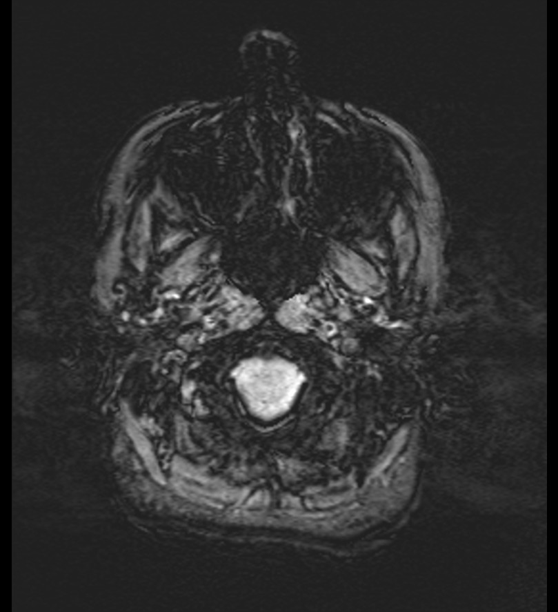 Choroid plexus xanthogranuloma (Radiopaedia 91271-108875 Axial SWI 6).jpg