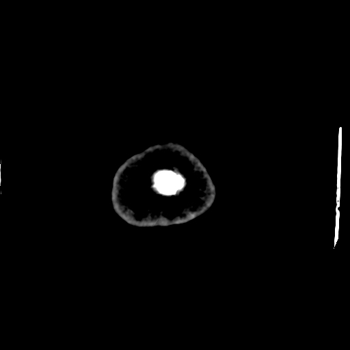 Choroid plexus xanthogranulomas (Radiopaedia 51621-57408 Axial non-contrast 121).jpg