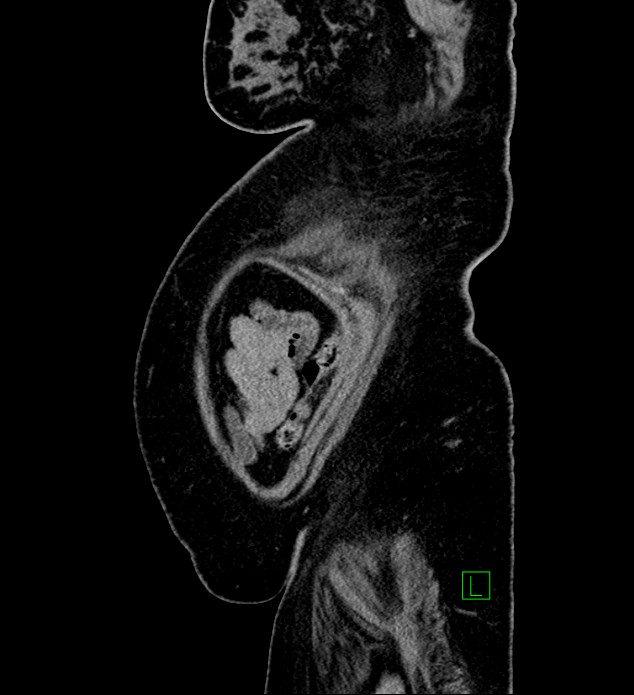 Chromophobe renal cell carcinoma (Radiopaedia 84239-99519 G 11).jpg