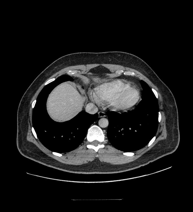 Chromophobe renal cell carcinoma (Radiopaedia 84337-99644 C 13).jpg