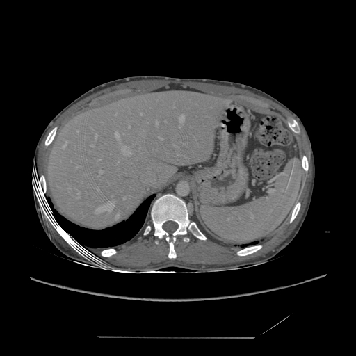 File:Chronic IVC thrombosis and resultant IVC filter malposition (Radiopaedia 81158-94800 A 18).jpg