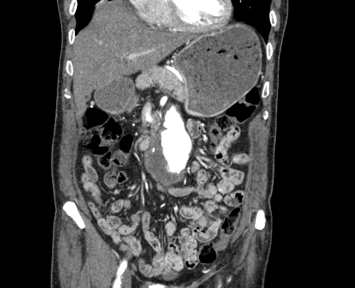 File:Chronic contained rupture of abdominal aortic aneurysm with extensive erosion of the vertebral bodies (Radiopaedia 55450-61901 D 16).jpg