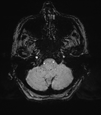 Chronic hypertensive encephalopathy (Radiopaedia 39993-42482 Axial SWI 12).png