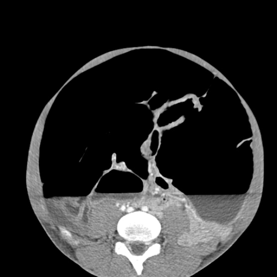 Chronic large bowel pseudo-obstruction (Radiopaedia 43181-46492 A 115).jpg