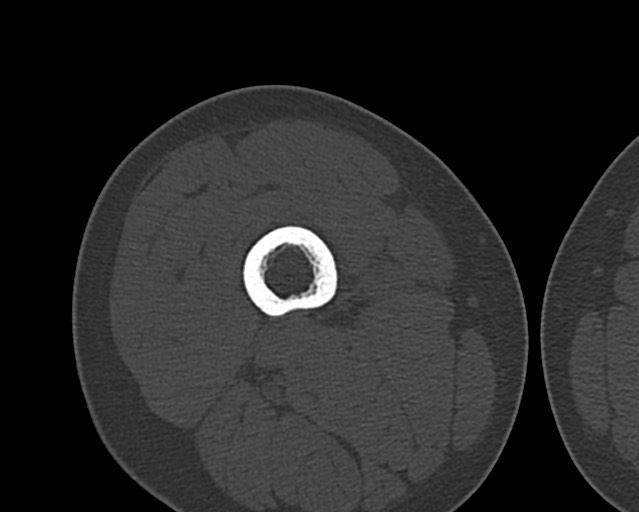 File:Chronic ostemyelitis of the femur with long sinus tract (Radiopaedia 74947-85982 Axial bone window 83).jpg