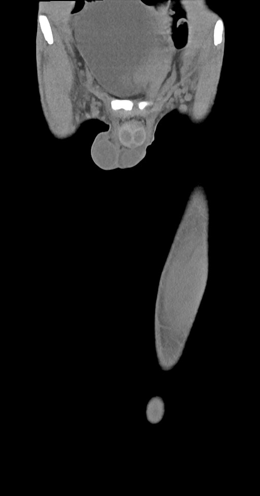 Chronic osteomyelitis (with sequestrum) (Radiopaedia 74813-85822 E 6).jpg