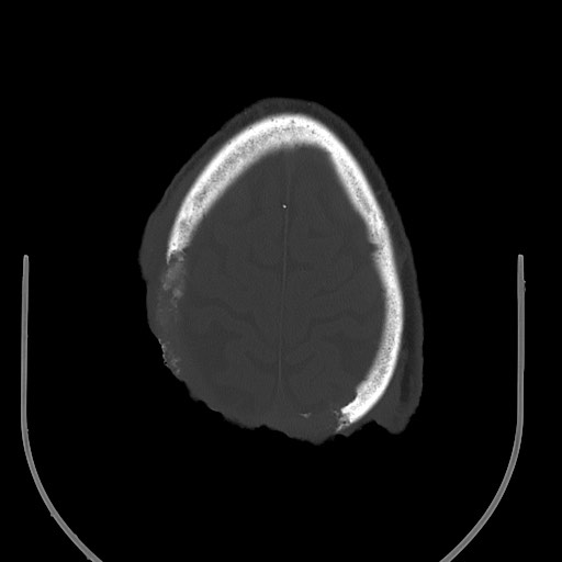 Chronic osteomyelitis - calvarial (severe) (Radiopaedia 69668-79616 Axial bone window 64).jpg