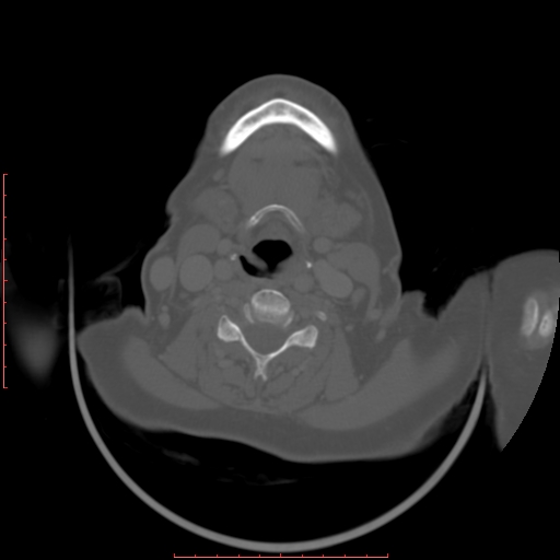 Chronic osteomyelitis - maxilla (Radiopaedia 23783-23927 Axial bone window 7).jpg