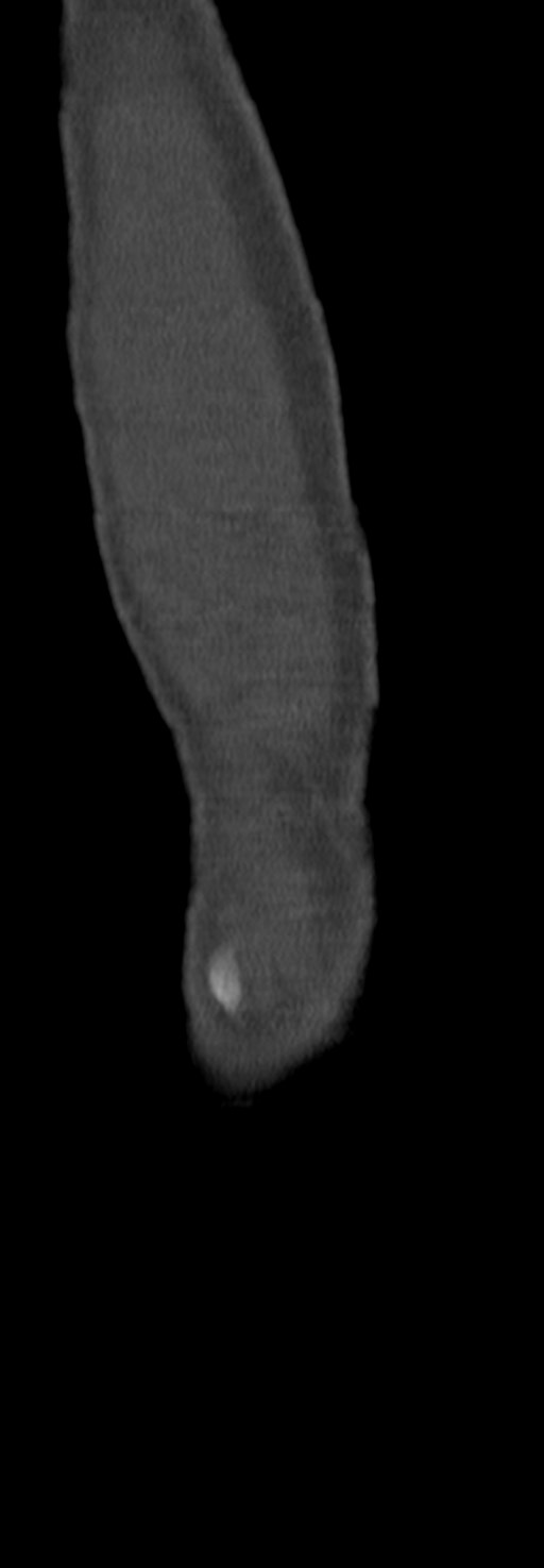 Chronic osteomyelitis of the distal humerus (Radiopaedia 78351-90971 Sagittal bone window 67).jpg