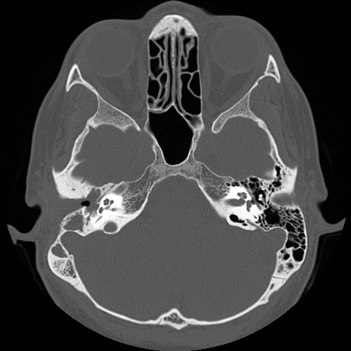 File:Chronic otomastoiditis (Radiopaedia 27138-27309 Axial bone window 32).jpg
