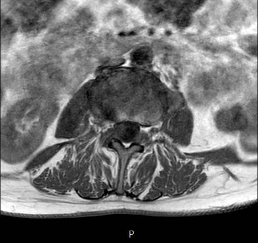 File:Chronic spinal hematoma with cauda equina syndrome (Radiopaedia 75745-87090 Axial T1 13).png