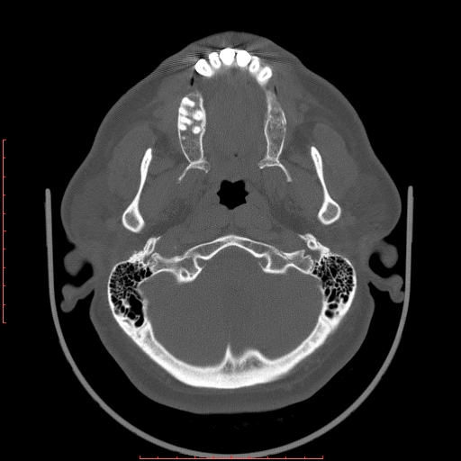 Chronic submandibular sialolithiasis (Radiopaedia 69817-79814 Axial bone window 2).jpg