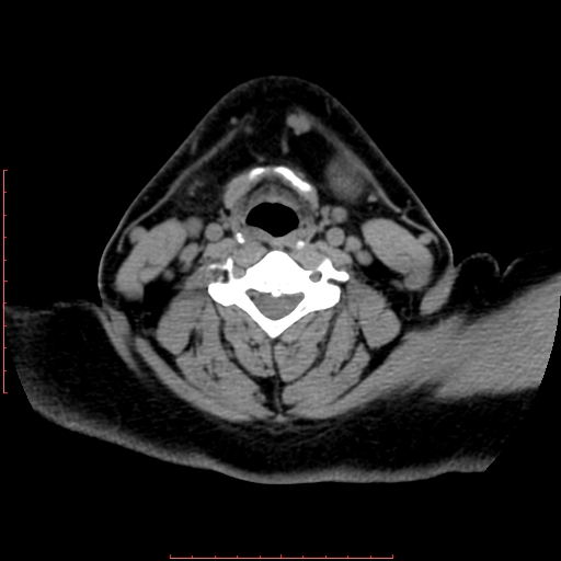 Chronic submandibular sialolithiasis (Radiopaedia 69817-79814 Axial non-contrast 153).jpg
