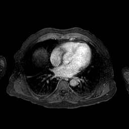 Cirrhosis and hepatocellular carcinoma in the setting of hemochromatosis (Radiopaedia 75394-86594 Axial T1 C+ fat sat 258).jpg