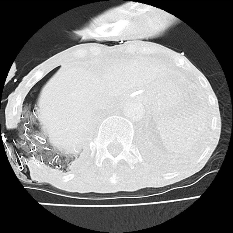 Clagett thoracotomy with bronchopleural fistula (Radiopaedia 29192-29587 Axial lung window 46).jpg