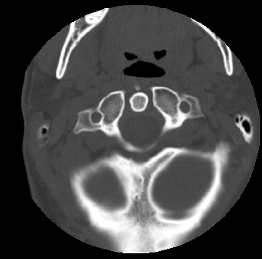 Clay-shoveler fracture (Radiopaedia 22568-22590 Axial bone window 10).jpg