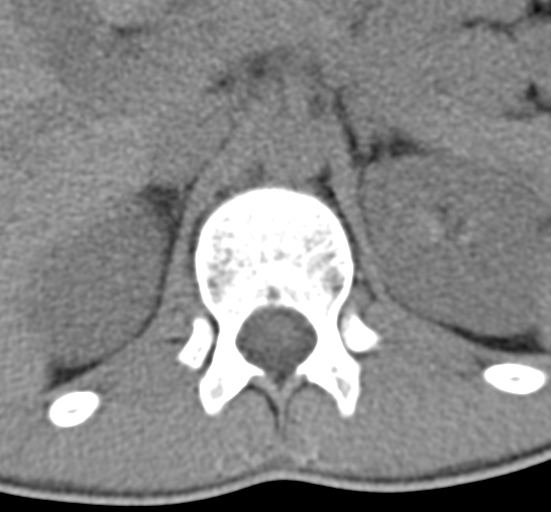 Clear cell meningoma - lumbar spine (Radiopaedia 60116-67691 Axial non-contrast 3).png