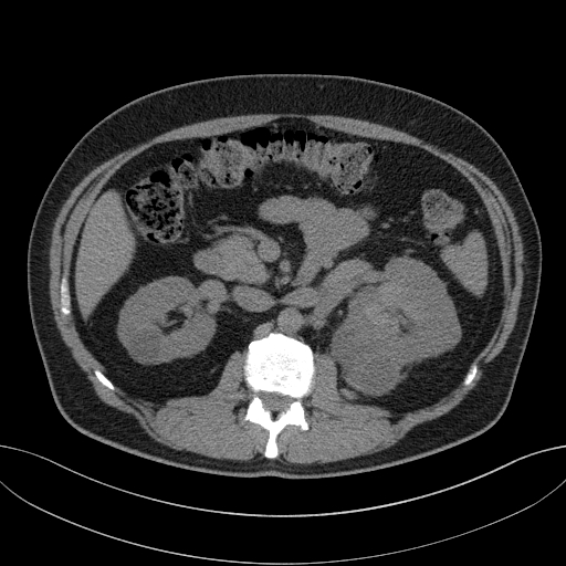 File:Clear cell renal cell carcinoma (Radiopaedia 61449-69393 Axial non-contrast 34).jpg