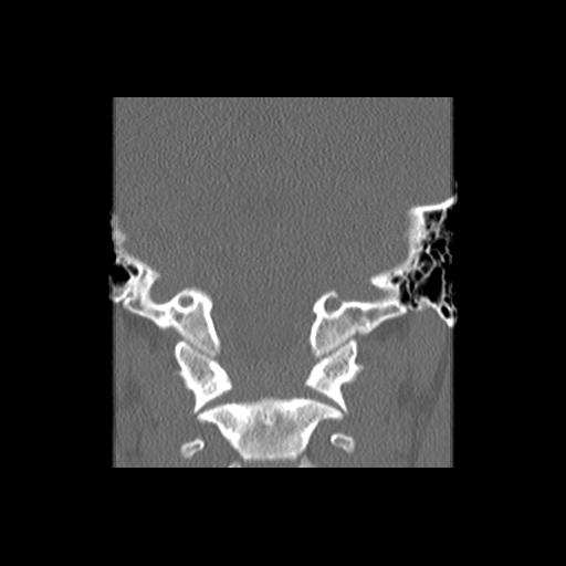File:Cleft hard palate and alveolus (Radiopaedia 63180-71710 Coronal bone window 43).jpg