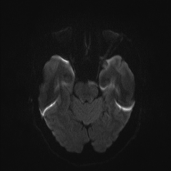 File:Clival meningioma (Radiopaedia 53278-59248 Axial DWI 33).jpg