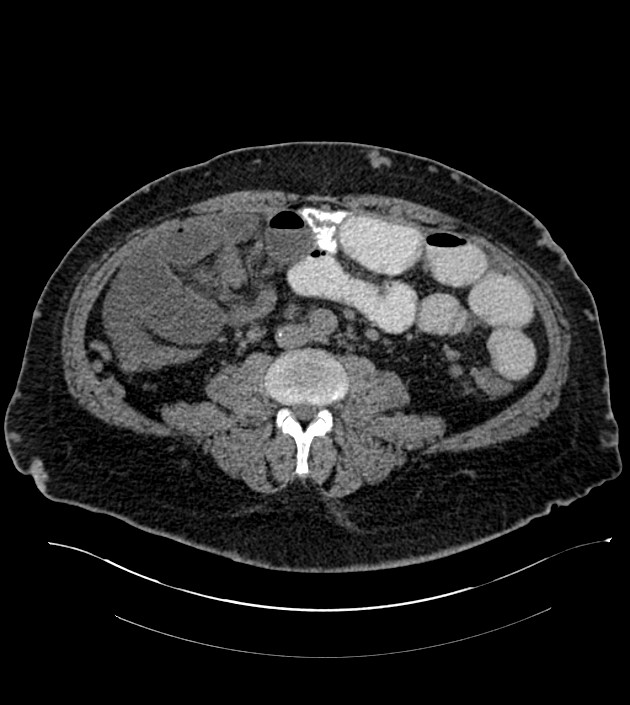 Closed-loop small bowel obstruction-internal hernia (Radiopaedia 78439-91096 Axial non-contrast 90).jpg