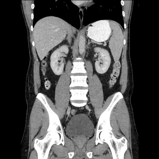 Closed-loop small bowel obstruction (Radiopaedia 73713-84509 C 74).jpg