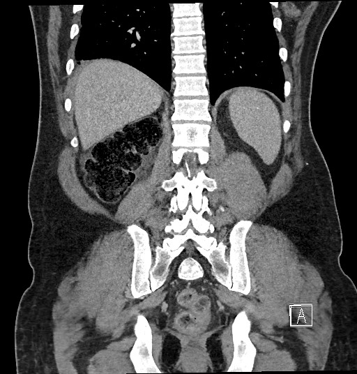 Closed loop obstruction - internal hernia into nephrectomy bed (Radiopaedia 59867-67320 B 107).jpg