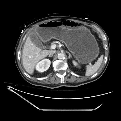 Closed loop obstruction due to adhesive band, resulting in small bowel ischemia and resection (Radiopaedia 83835-99023 D 47).jpg
