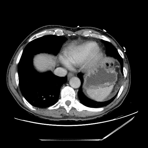 Closed loop small bowel obstruction - omental adhesion causing "internal hernia" (Radiopaedia 85129-100682 A 13).jpg