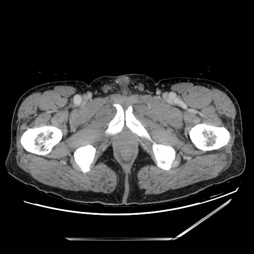 Closed loop small bowel obstruction - omental adhesion causing "internal hernia" (Radiopaedia 85129-100682 A 180).jpg