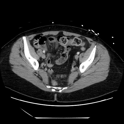 File:Closed loop small bowel obstruction due to adhesive bands - early and late images (Radiopaedia 83830-99014 A 125).jpg