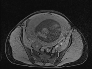 Closed loop small bowel obstruction in pregnancy (MRI) (Radiopaedia 87637-104031 F 41).jpg
