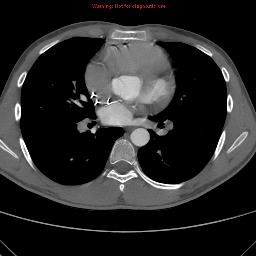 File:Coarctation of the aorta (Radiopaedia 9434-10118 A 104).jpg