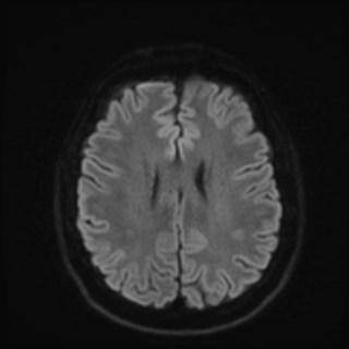 File:Cochlear incomplete partition type III associated with hypothalamic hamartoma (Radiopaedia 88756-105498 Axial DWI 67).jpg