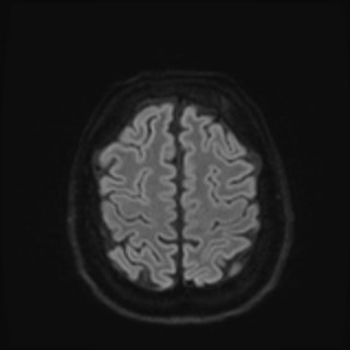 File:Cochlear incomplete partition type III associated with hypothalamic hamartoma (Radiopaedia 88756-105498 Axial DWI 74).jpg