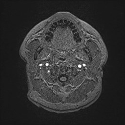 File:Cochlear incomplete partition type III associated with hypothalamic hamartoma (Radiopaedia 88756-105498 Axial T1 9).jpg