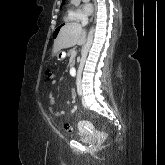 File:Collection due to leak after sleeve gastrectomy (Radiopaedia 55504-61972 C 35).jpg