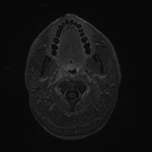 Colloid cyst (Radiopaedia 44510-48181 Axial T1 C+ 1).png